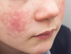 eczema 3