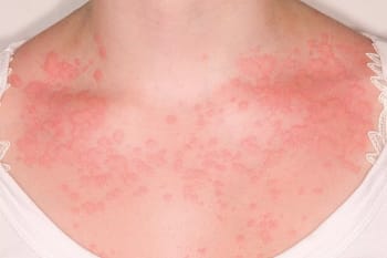 Chronic Spontaneous Urticaria 4